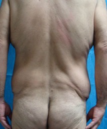 Paciente masculino, ANTES de Cirugía Circunferencial