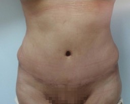 Paciente femenino, DESPUÉS de Cirugía Contorno inferior: Abdomen