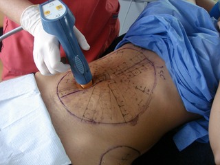 Procedimiento de Thermage en abdomen